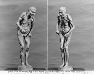 Beeldje van een oude vrouw met de ziekte van Parkinson, na 1895